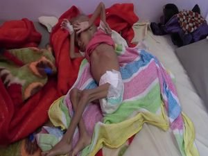 Yemen'de insanlık can çekişiyor